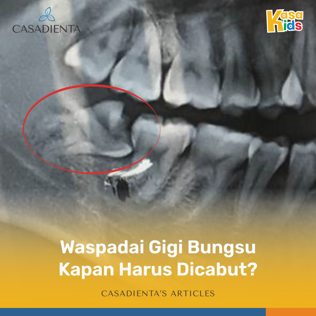 Waspadai Gigi Bungsu: Kapan Harus Dicabut?