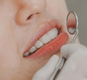 Perawatan Scaling dan Dental Spa di Casadienta Dental Clinic